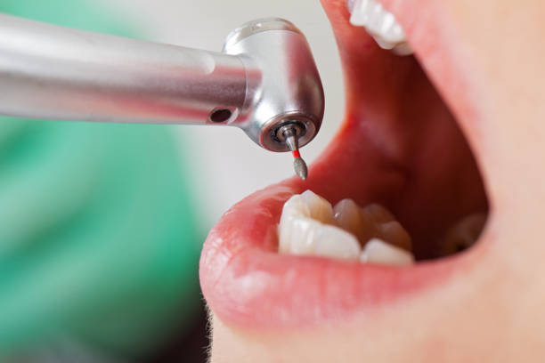 Best Emergency Dentist for Lost Fillings or Crowns in Hayfork, CA